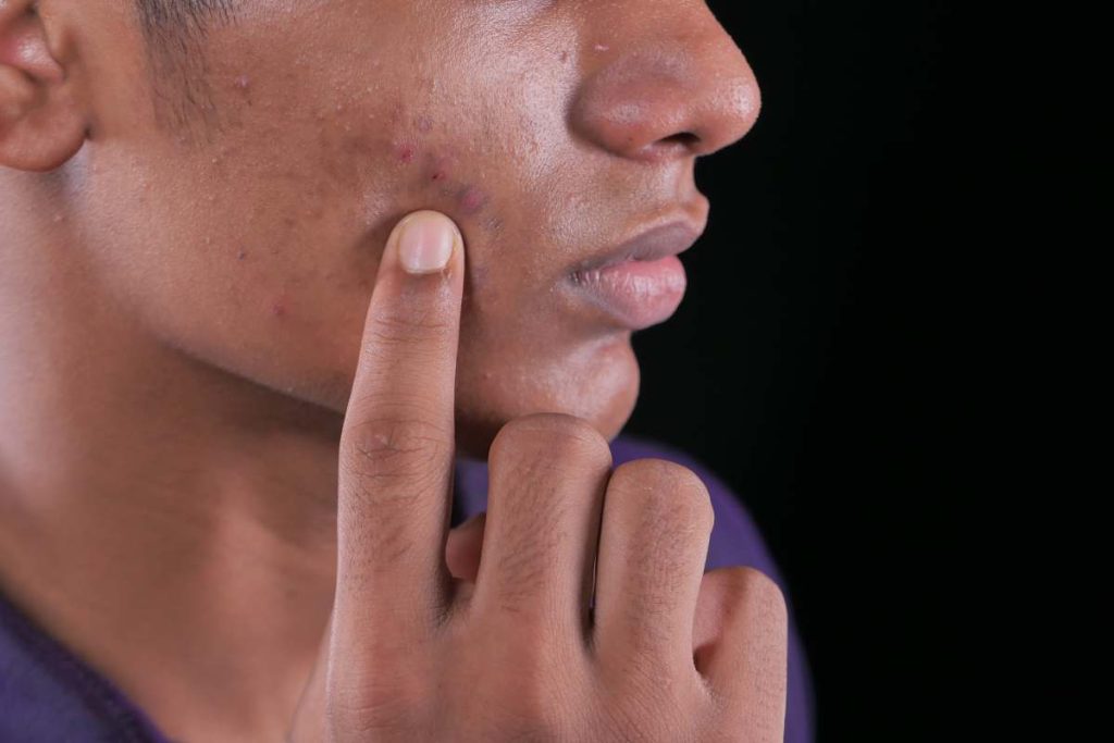 close up of young man face with skin problem